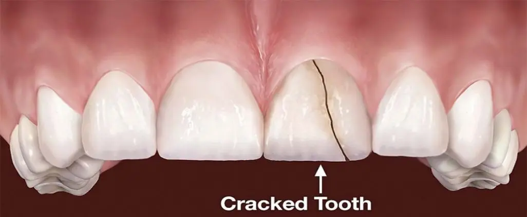 Cracked tooth: what to do