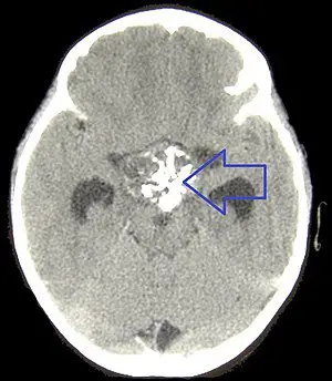 Craniopharyngiome