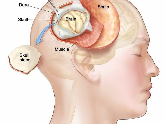 Craniotomy