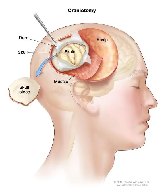 Craniotomy