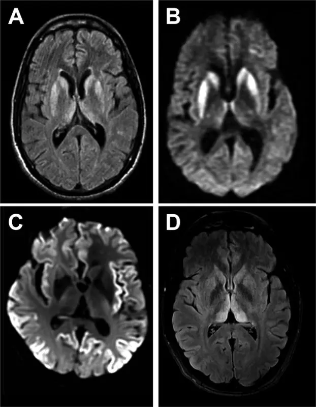 Creutzfeldt-Jakob disease