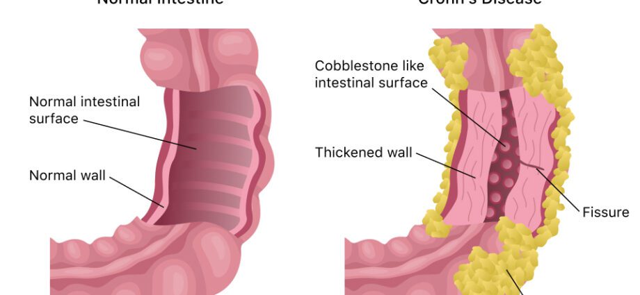 Crohn&#8217;s disease