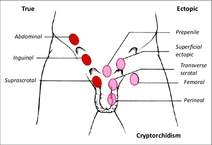 Cryptorchidism or testicular ectopia, what is it?