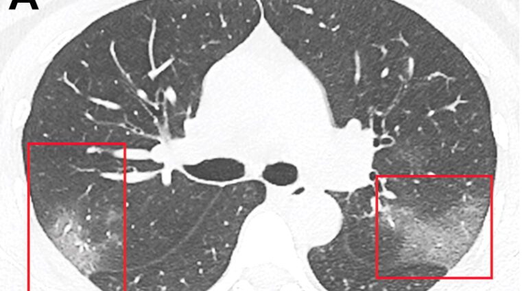 CT scan for coronavirus: when is it better to do and what it can show