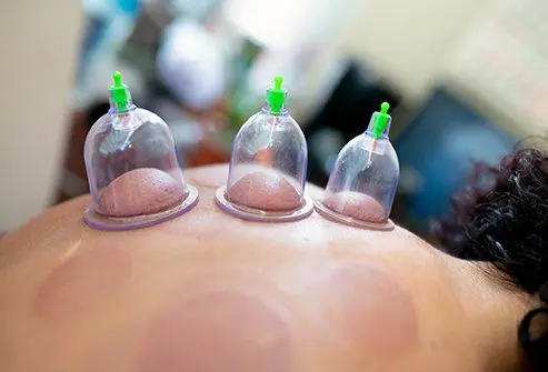 Cupping therapy: what is it?