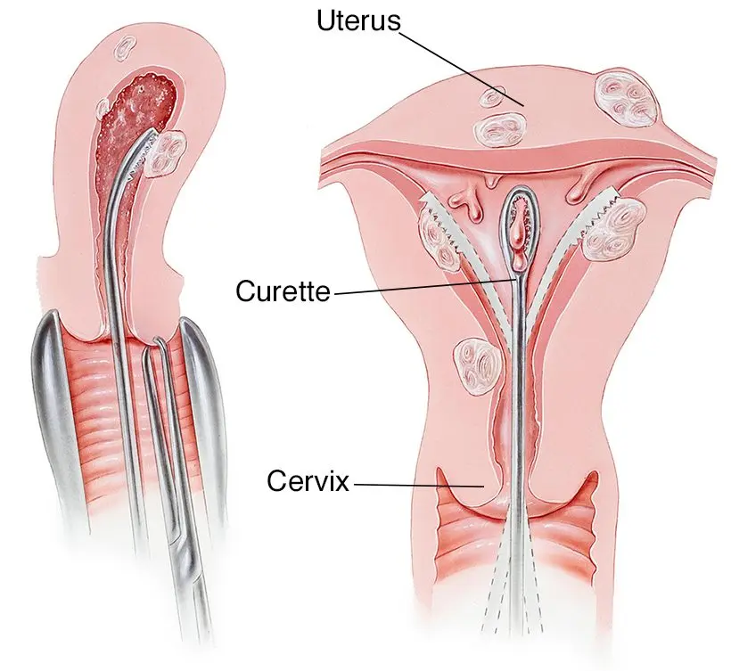 Curettage: what is curettage after miscarriage?