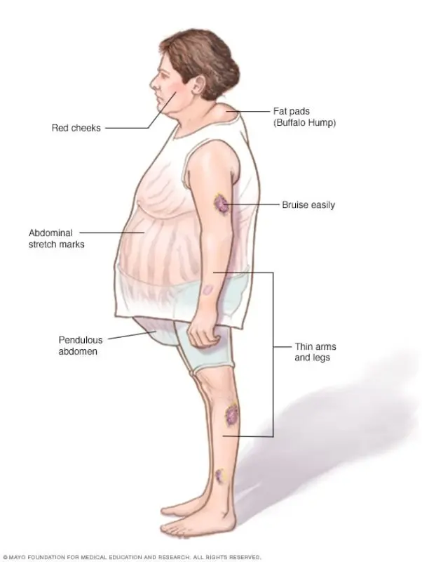 Cushing&#8217;s Syndrome