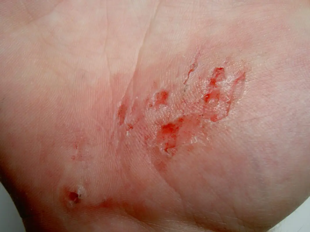 Cuts and abrasions on the hands: treating minor injuries. Video