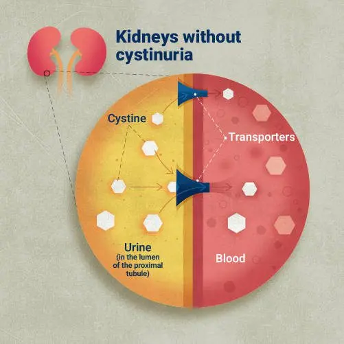 Cystinuria: definition, causes and natural treatments