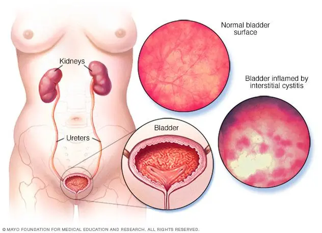 Cystitis, an inflammation of the bladder