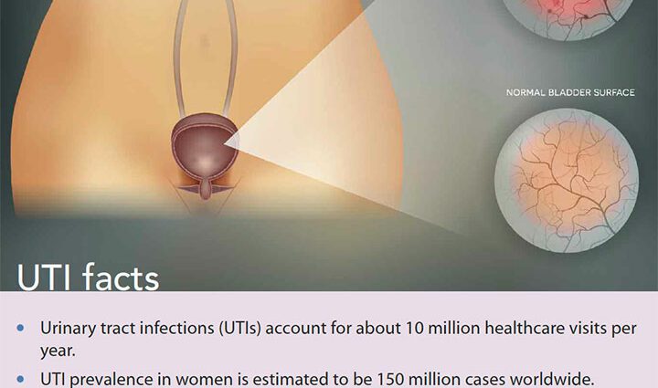 Cystitis: causes and treatment of the disease. Video