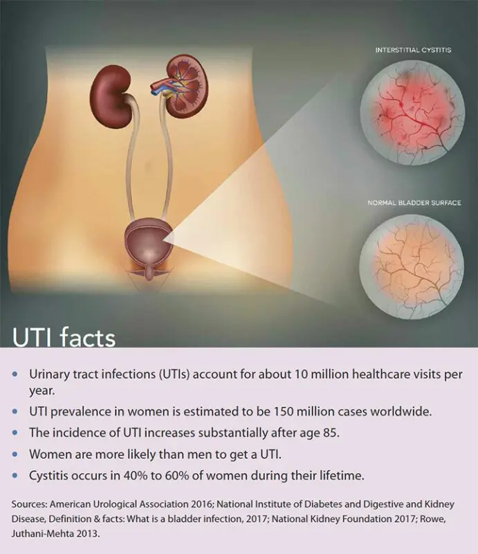 Cystitis: causes and treatment of the disease. Video