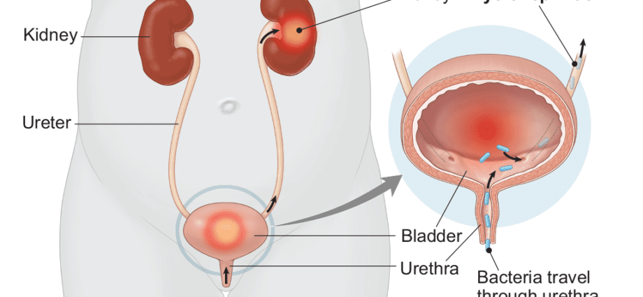 Signs and symptoms of cystitis during pregnancy