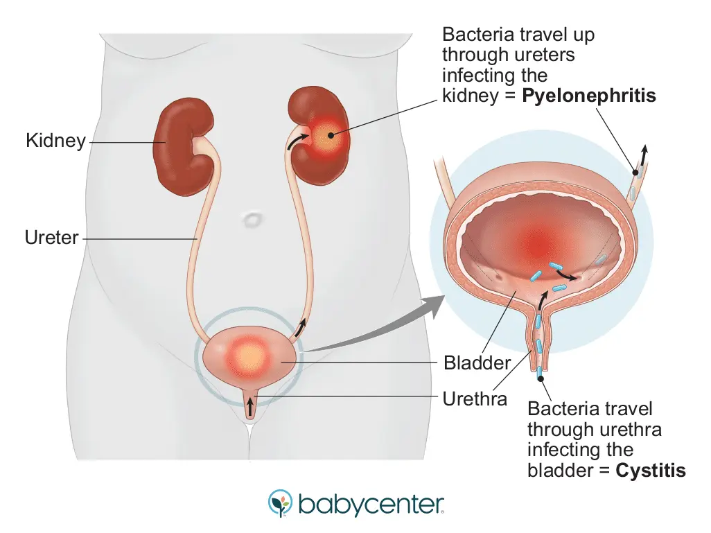 Signs and symptoms of cystitis during pregnancy