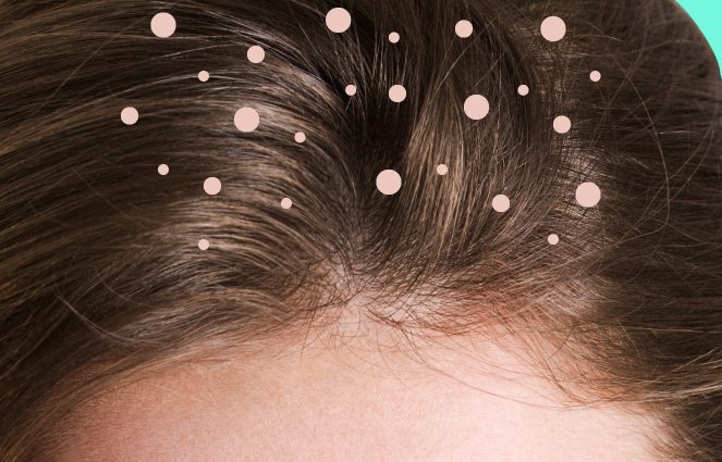 Dandruff in hair: where do they come from?