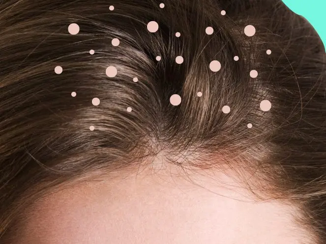 Dandruff in hair: where do they come from?