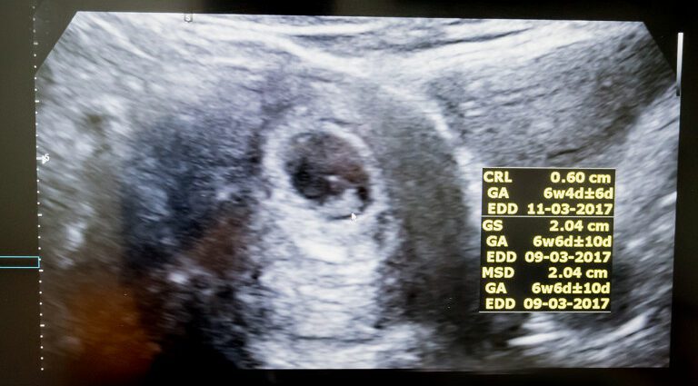 Dating ultrasound: 1st ultrasound