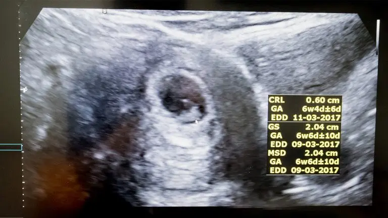 Dating ultrasound: the 1st ultrasound