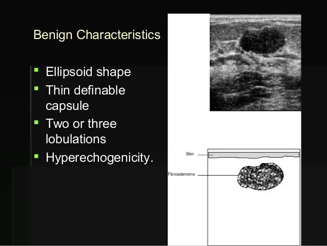 Definition of breast ultrasound