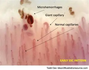 Definition of capillaroscopy