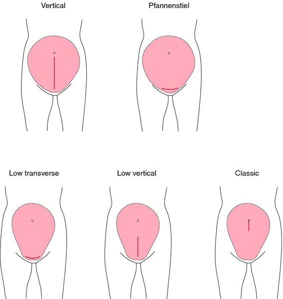 Definition of Cesarean