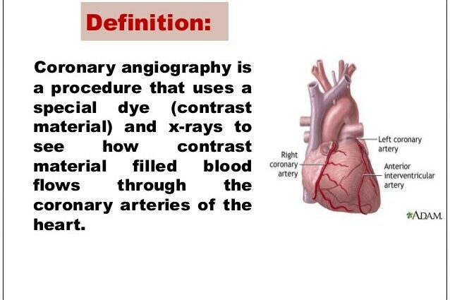 Definición de anxiografía coronaria