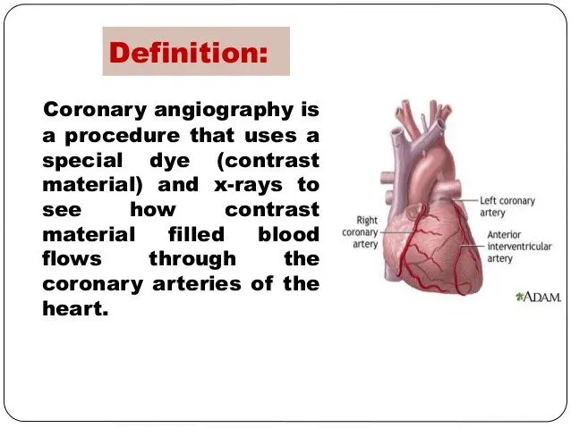 Definition of coronary angiography