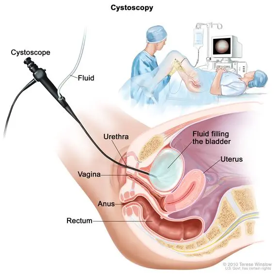 Definition of cystoscopy