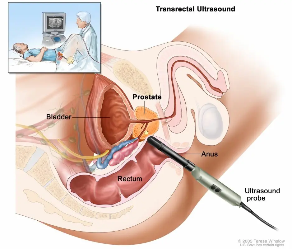 Definition of endorectal prostate ultrasound