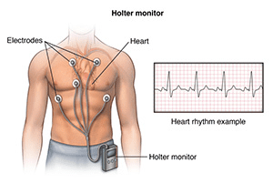 Definición de Holter