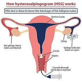 Definition of hysterosalpingography