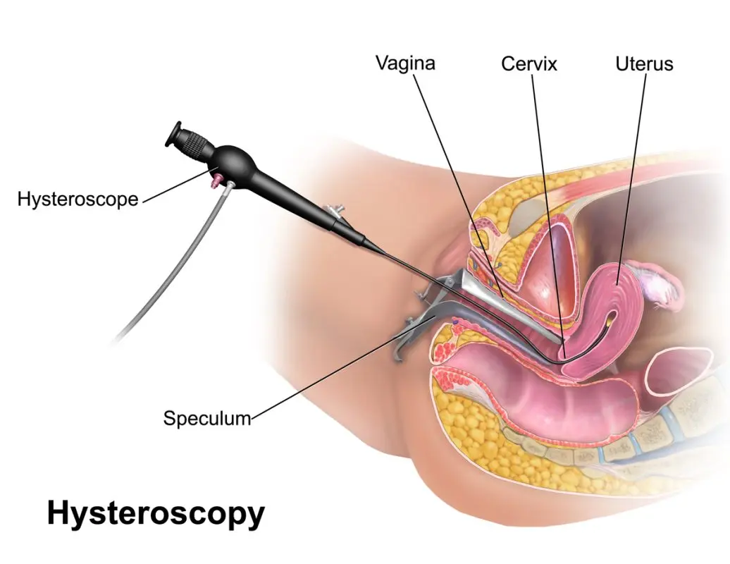 Definition of hysteroscopy