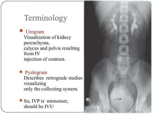 Definition of intravenous urography