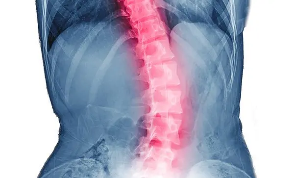 Definition of lumbar arthrodesis