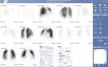 Definition of lung scintigraphy