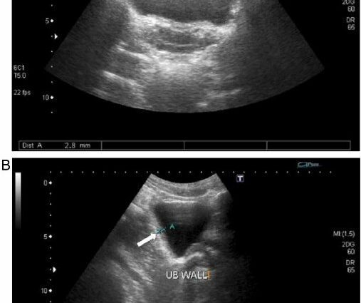 Definition of urinary tract ultrasound