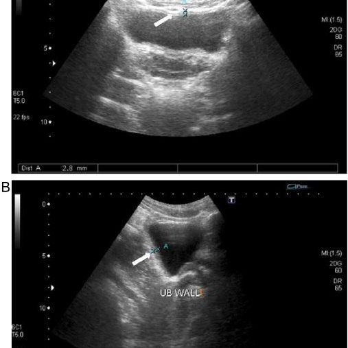 Definition of urinary tract ultrasound - Healthy Food Near Me