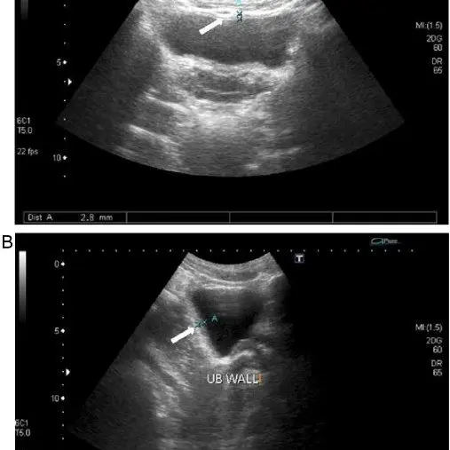 Definition of urinary tract ultrasound