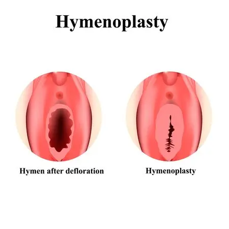 Defloration: how does the rupture of the hymen work?