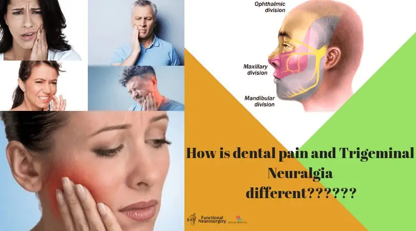 Dental neuralgia