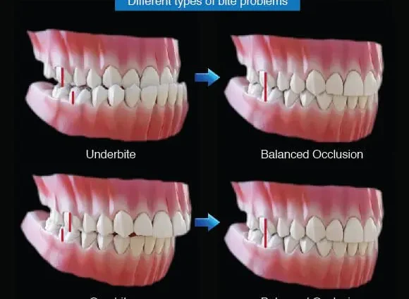 Dental occlusion