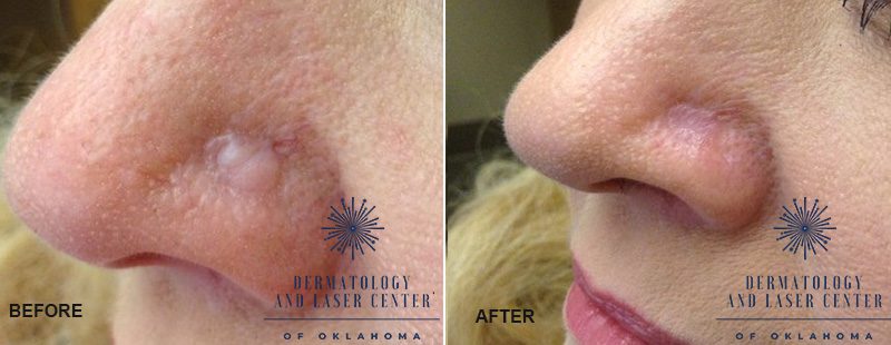 Dermabrasion: a solution to treat scars?