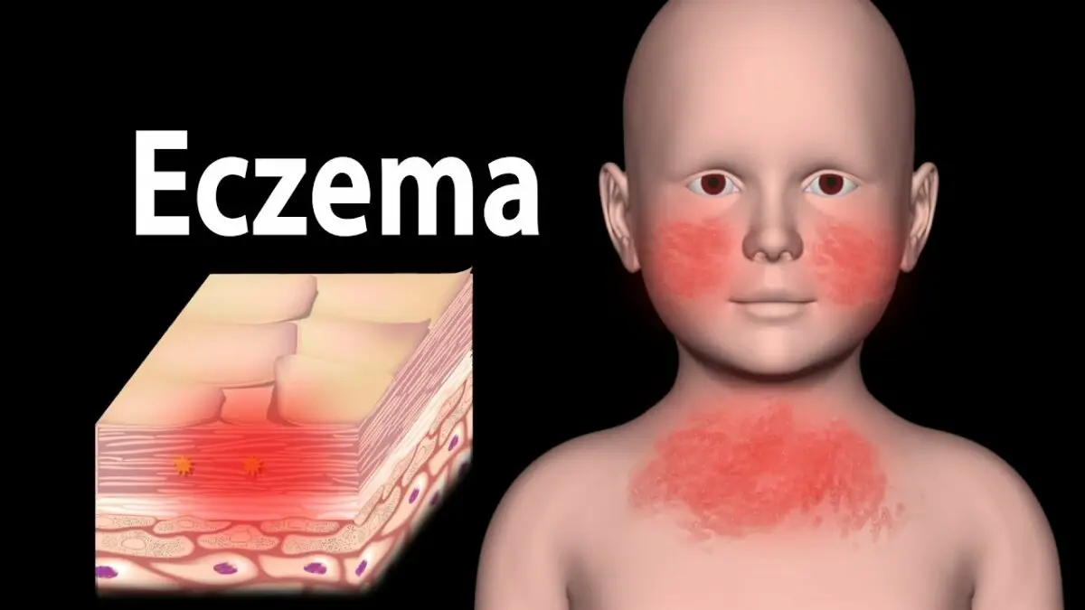 Dermatitis of the skin: symptoms, treatment. Video