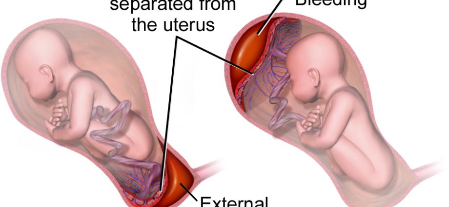 Отлепване на плацентата: какво е това?