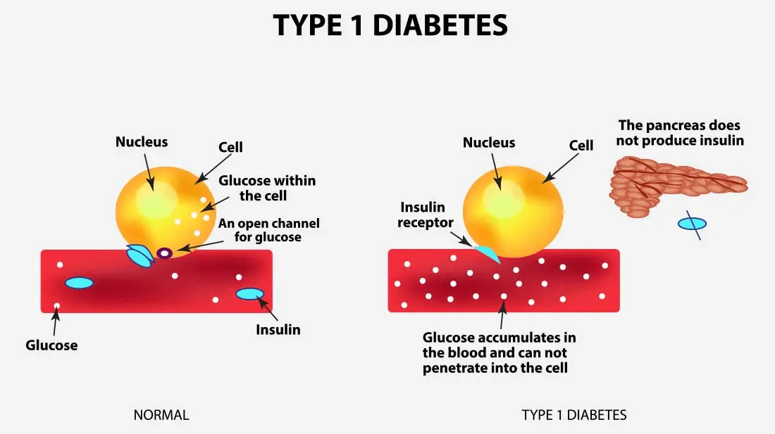 Diabetes type 1