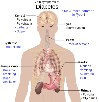 Diabetes type 2