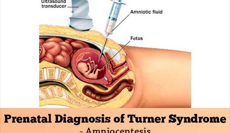 Diagnóstico da síndrome de Turner