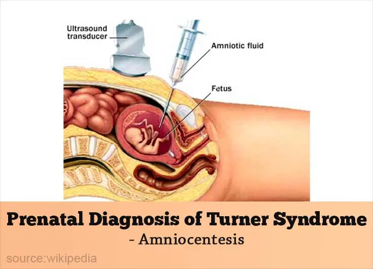 Diagnosis of Turner syndrome