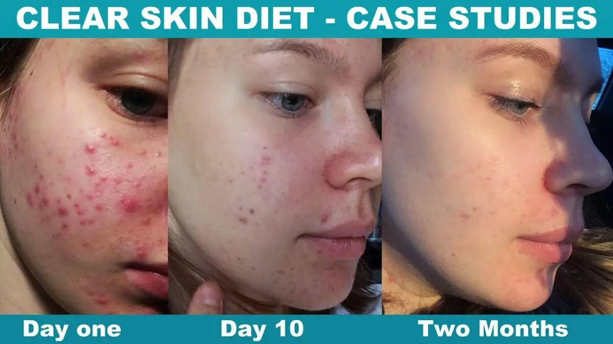 Diet for acne on the face. Video Tips