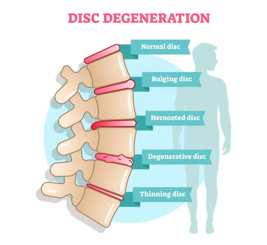 Disc disease
